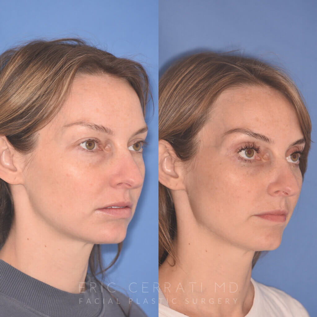 36 YR - 2 Months Postop: Upper Blepharoplasty, Lower Blepharoplasty, Fat Transfer
