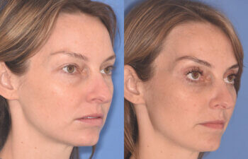 36 YR - 2 Months Postop: Upper Blepharoplasty, Lower Blepharoplasty, Fat Transfer