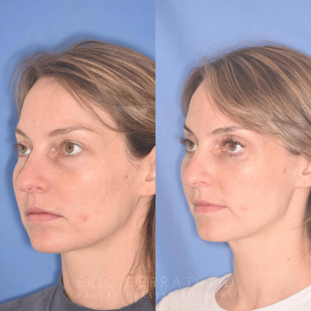 36 YR - 2 Months Postop: Upper Blepharoplasty, Lower Blepharoplasty, Fat Transfer