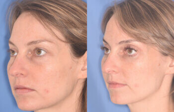 36 YR - 2 Months Postop: Upper Blepharoplasty, Lower Blepharoplasty, Fat Transfer