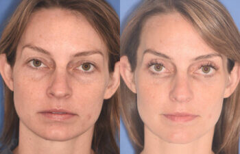 36 YR - 2 Months Postop: Upper Blepharoplasty, Lower Blepharoplasty, Fat Transfer
