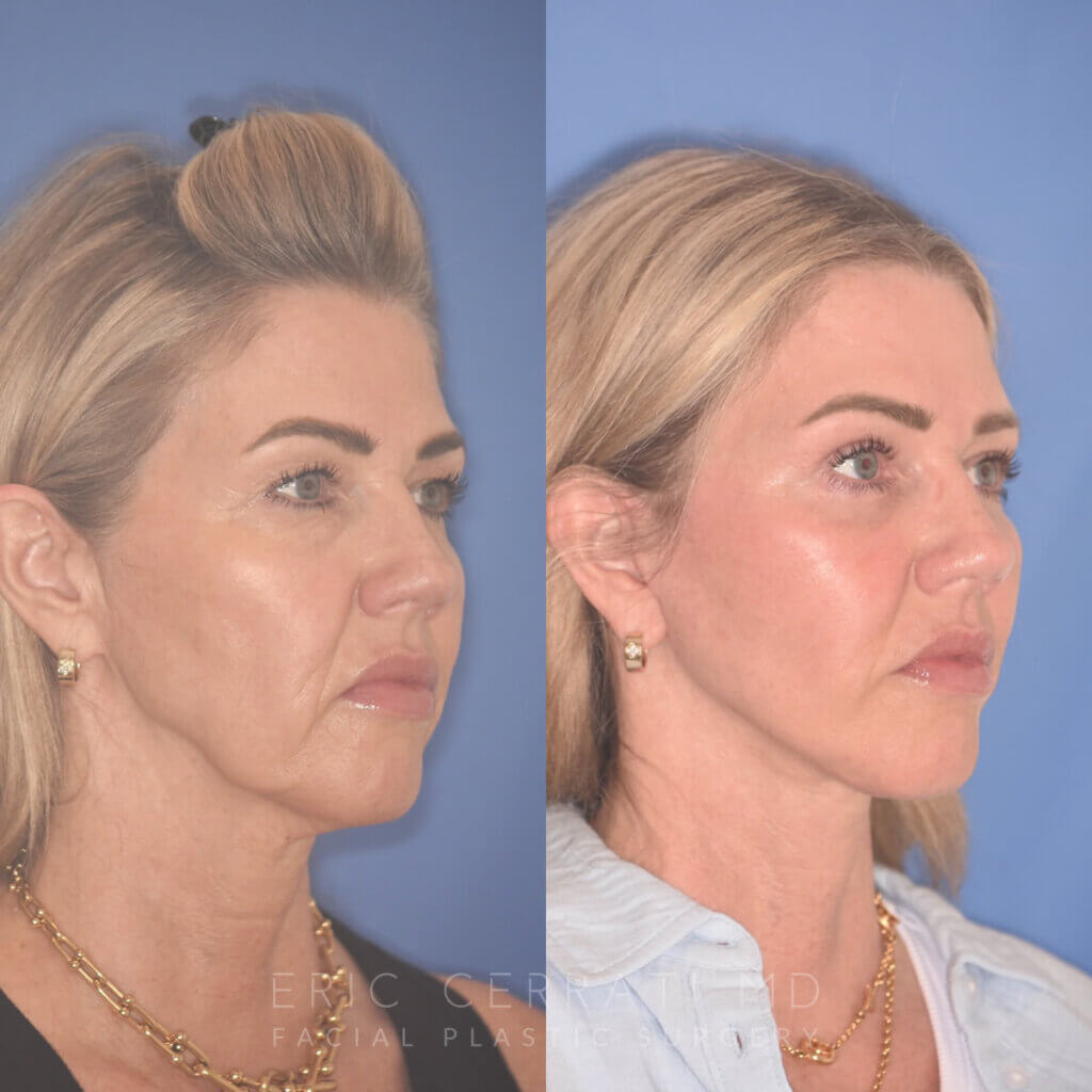 52 YR - 3.5 Months Postop: Endoscopic Browlift, Upper Blepharoplasty, Lower Blepharoplasty, Facelift, Buccal Fat Reduction, Laser Resurfacing