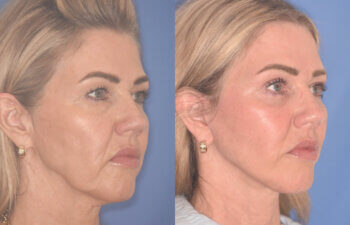 52 YR - 3.5 Months Postop: Endoscopic Browlift, Upper Blepharoplasty, Lower Blepharoplasty, Facelift, Buccal Fat Reduction, Laser Resurfacing