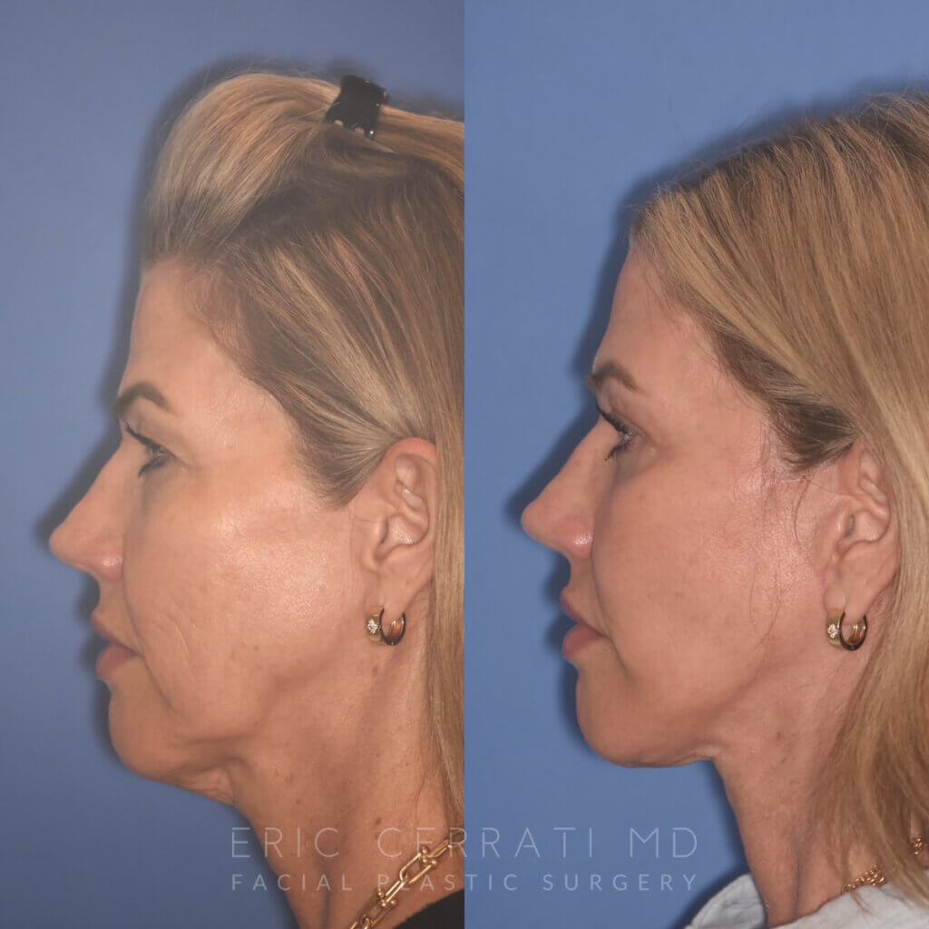 52 YR - 3.5 Months Postop: Endoscopic Browlift, Upper Blepharoplasty, Lower Blepharoplasty, Facelift, Buccal Fat Reduction, Laser Resurfacing