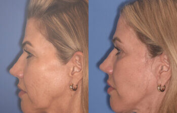 52 YR - 3.5 Months Postop: Endoscopic Browlift, Upper Blepharoplasty, Lower Blepharoplasty, Facelift, Buccal Fat Reduction, Laser Resurfacing