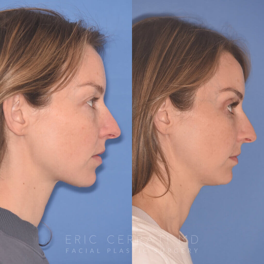 36 YR - 2 Months Postop: Upper Blepharoplasty, Lower Blepharoplasty, Fat Transfer