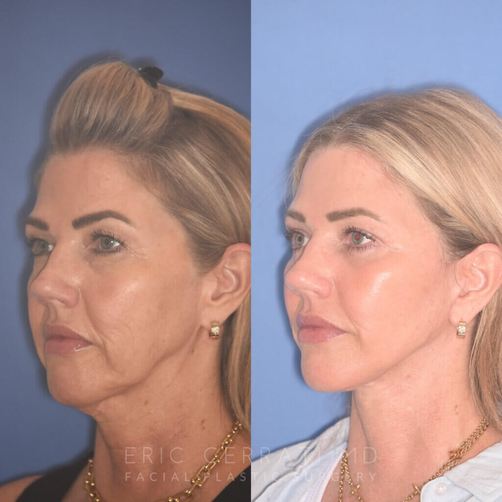 52 YR - 3.5 Months Postop: Endoscopic Browlift, Upper Blepharoplasty, Lower Blepharoplasty, Facelift, Buccal Fat Reduction, Laser Resurfacing