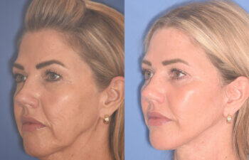 52 YR - 3.5 Months Postop: Endoscopic Browlift, Upper Blepharoplasty, Lower Blepharoplasty, Facelift, Buccal Fat Reduction, Laser Resurfacing