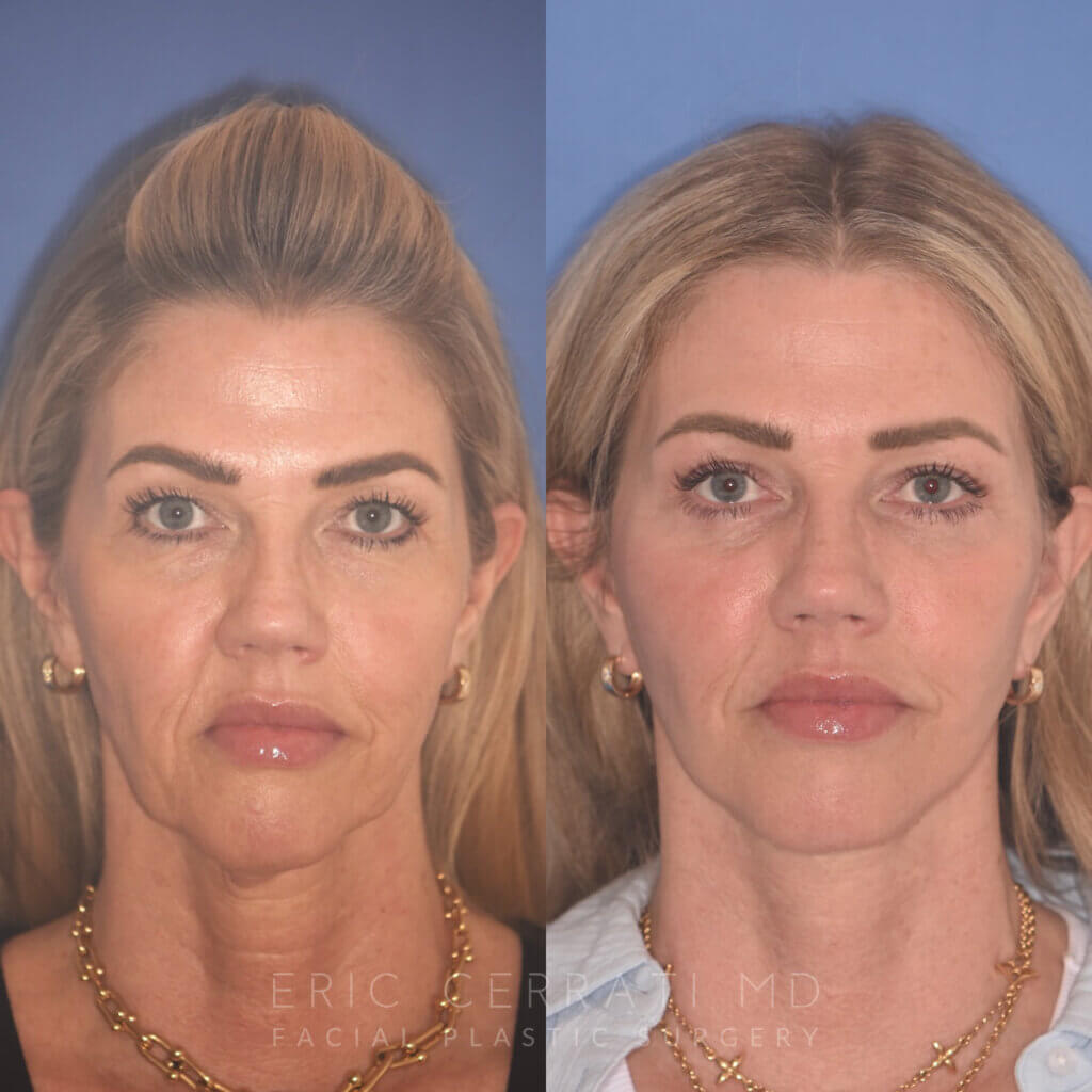 52 YR - 3.5 Months Postop: Endoscopic Browlift, Upper Blepharoplasty, Lower Blepharoplasty, Facelift, Buccal Fat Reduction, Laser Resurfacing