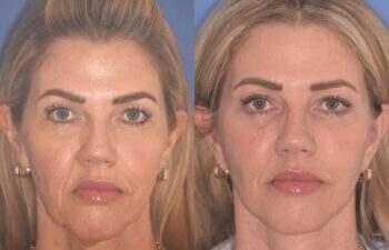 52 YR - 3.5 Months Postop: Endoscopic Browlift, Upper Blepharoplasty, Lower Blepharoplasty, Facelift, Buccal Fat Reduction, Laser Resurfacing