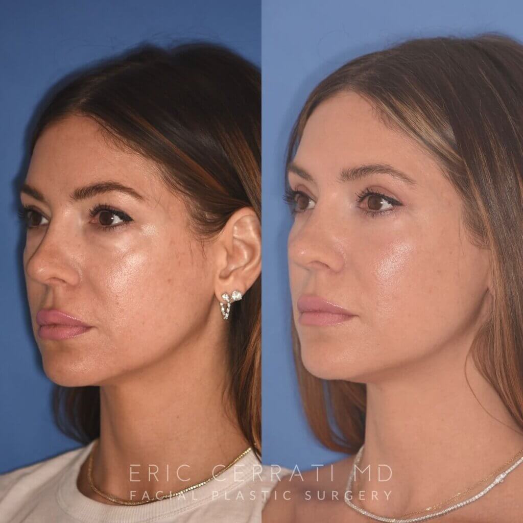 42 YR - 2 Months Postop: Upper Blepharoplasty + Lower Blepharoplasty + Laser