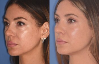 42 YR - 2 Months Postop: Upper Blepharoplasty + Lower Blepharoplasty + Laser