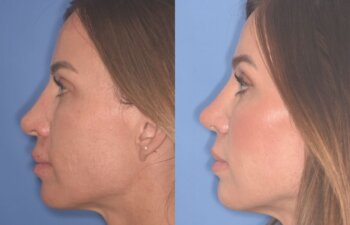 37 YR - 2 Months Postop: Rhinoplasty + Lower Blepharoplasty + Laser