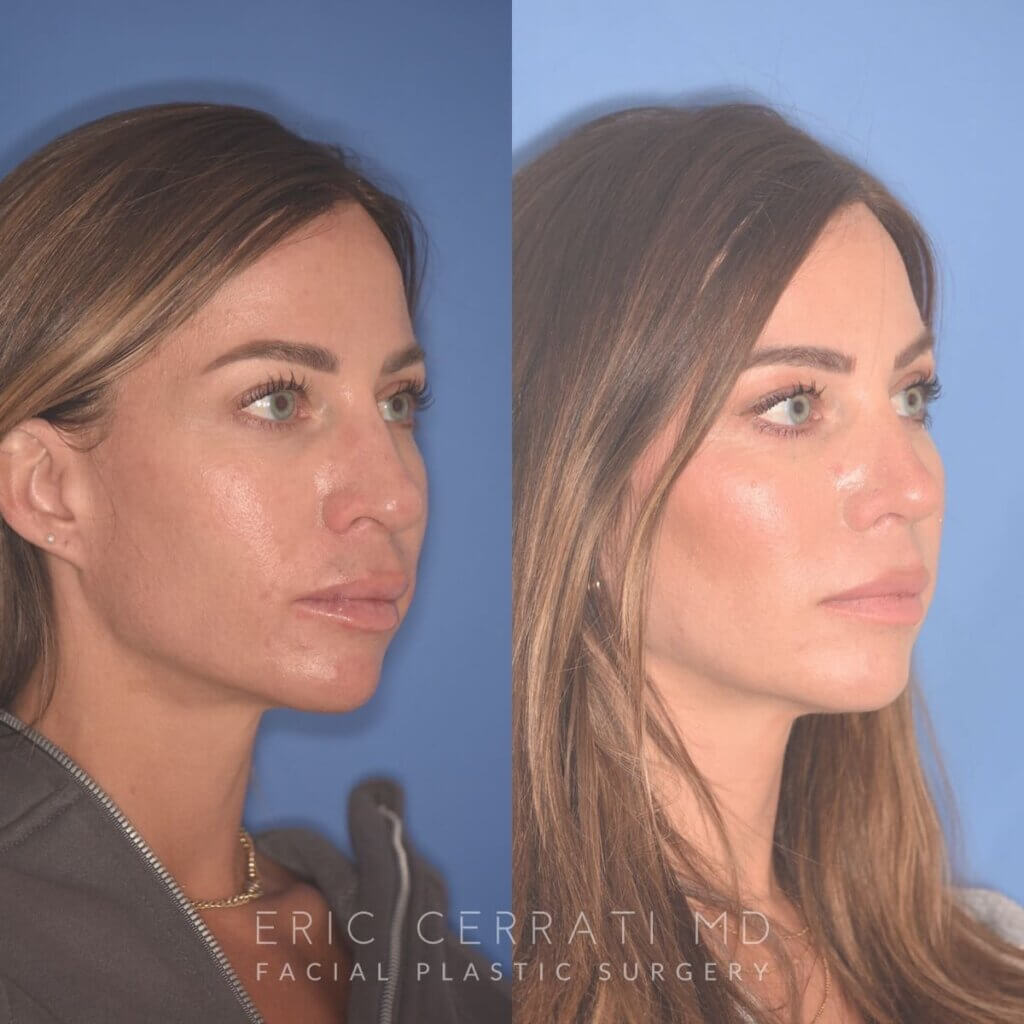 37 YR - 2 Months Postop: Rhinoplasty + Lower Blepharoplasty + Laser