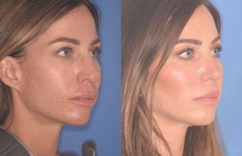 37 YR - 2 Months Postop: Rhinoplasty + Lower Blepharoplasty + Laser