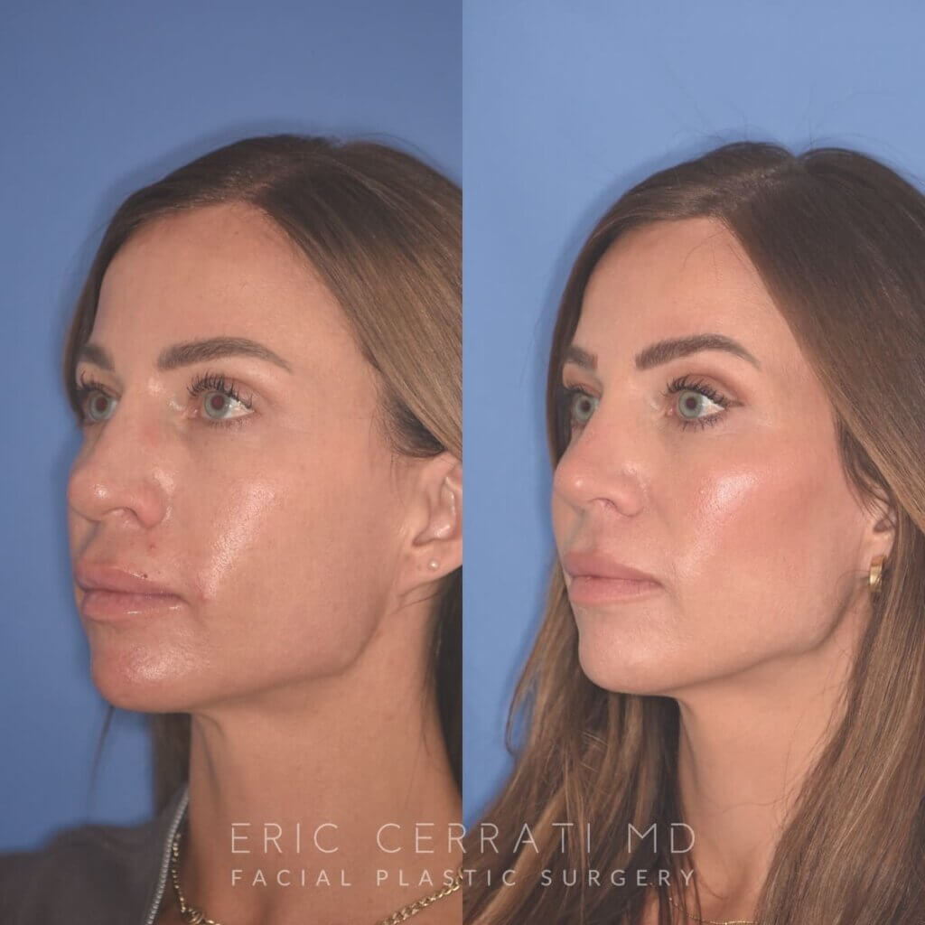 37 YR - 2 Months Postop: Rhinoplasty + Lower Blepharoplasty + Laser