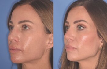 37 YR - 2 Months Postop: Rhinoplasty + Lower Blepharoplasty + Laser