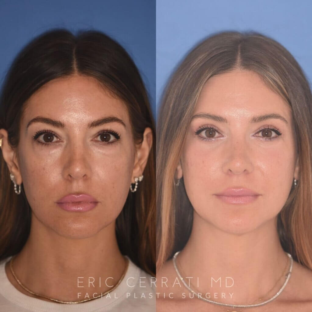 42 YR - 2 Months Postop: Upper Blepharoplasty + Lower Blepharoplasty + Laser