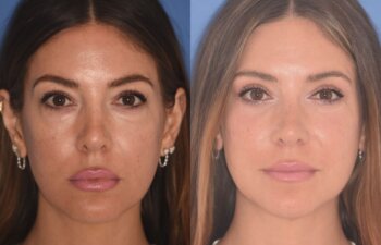 42 YR - 2 Months Postop: Upper Blepharoplasty + Lower Blepharoplasty + Laser