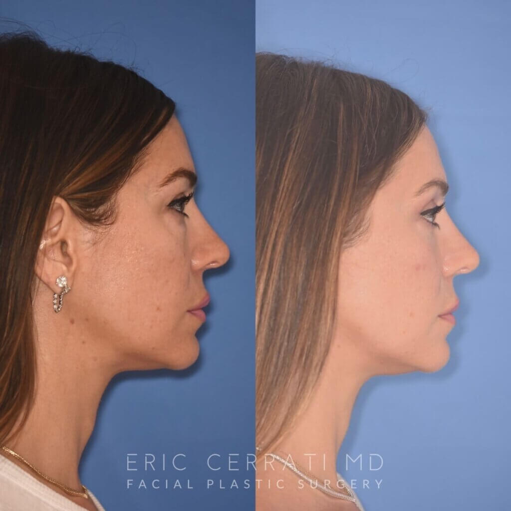 42 YR - 2 Months Postop: Upper Blepharoplasty + Lower Blepharoplasty + Laser