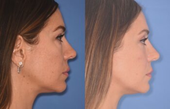 42 YR - 2 Months Postop: Upper Blepharoplasty + Lower Blepharoplasty + Laser