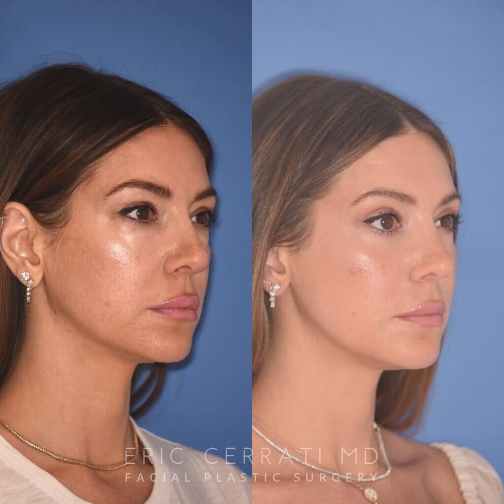 42 YR - 2 Months Postop: Upper Blepharoplasty + Lower Blepharoplasty + Laser
