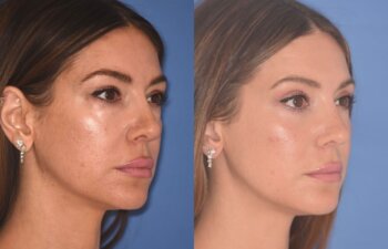 42 YR - 2 Months Postop: Upper Blepharoplasty + Lower Blepharoplasty + Laser