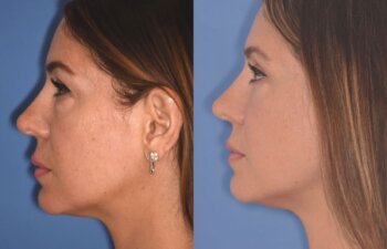 42 YR - 2 Months Postop: Upper Blepharoplasty + Lower Blepharoplasty + Laser