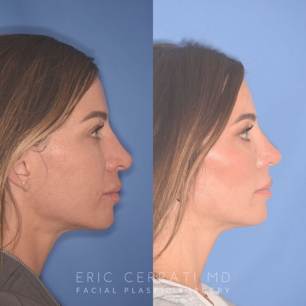 37 YR - 2 Months Postop: Rhinoplasty + Lower Blepharoplasty + Laser