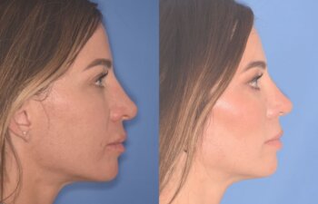 37 YR - 2 Months Postop: Rhinoplasty + Lower Blepharoplasty + Laser