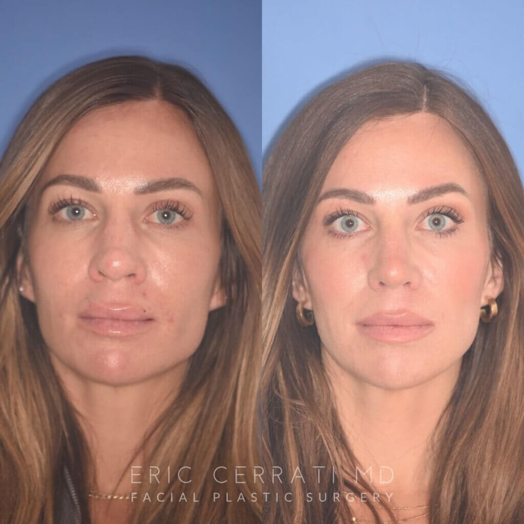 37 YR - 2 Months Postop: Rhinoplasty + Lower Blepharoplasty + Laser