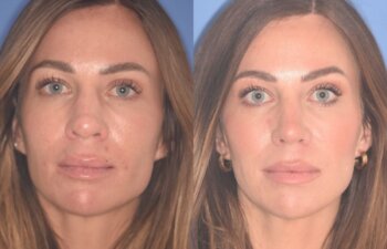 37 YR - 2 Months Postop: Rhinoplasty + Lower Blepharoplasty + Laser