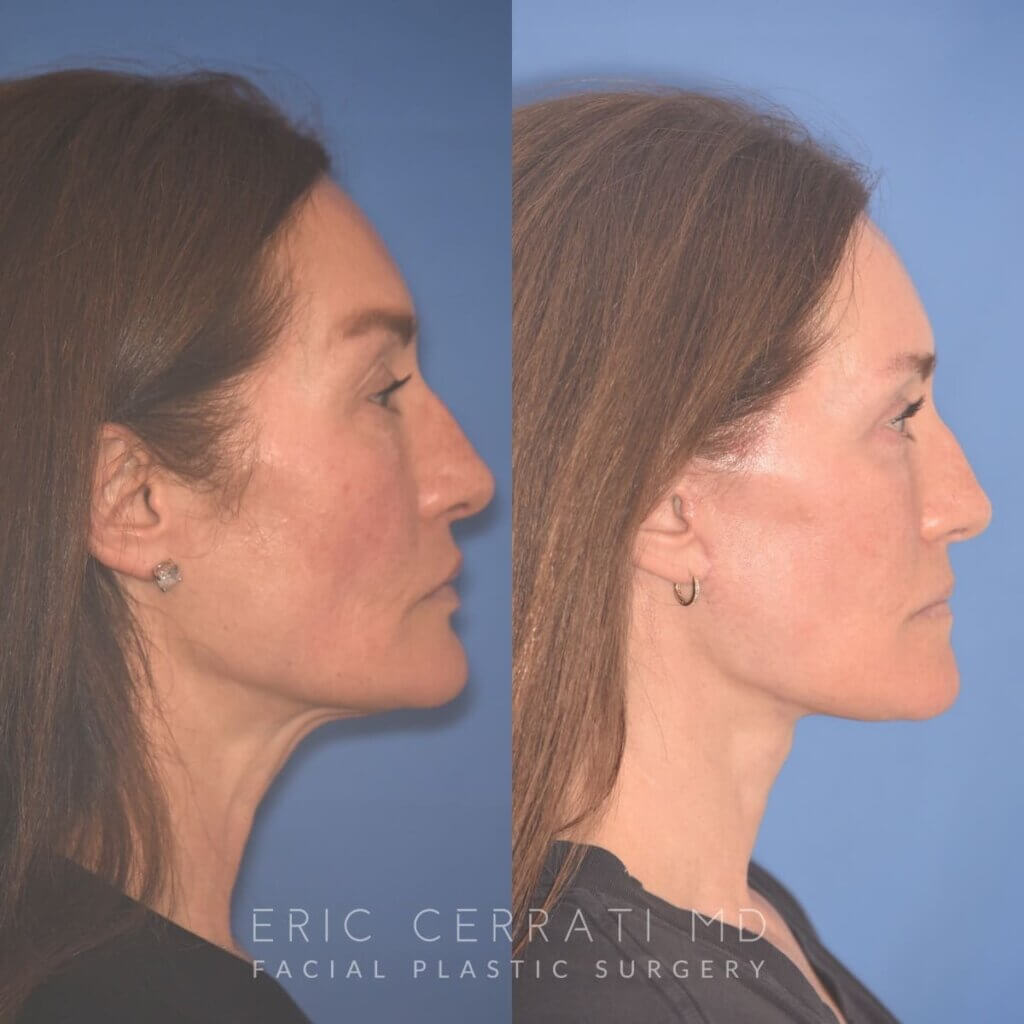 55 YR - 4 Months Postop: Facelift + Revision Upper Blepharoplasty +Lower Blepharoplasty + Laser