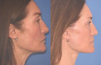 55 YR - 4 Months Postop: Facelift + Revision Upper Blepharoplasty +Lower Blepharoplasty + Laser