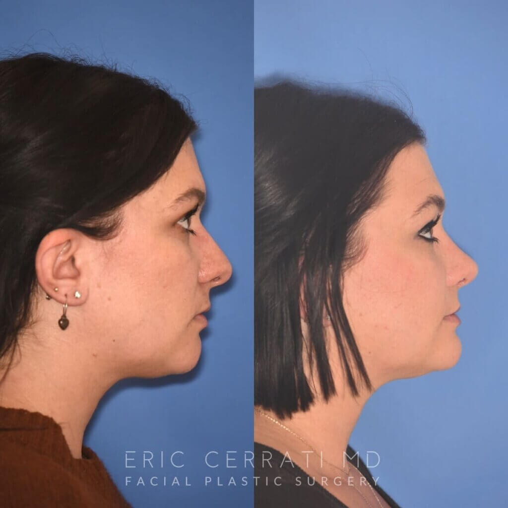 31 YR - 4 Months Postop: Rhinoplasty