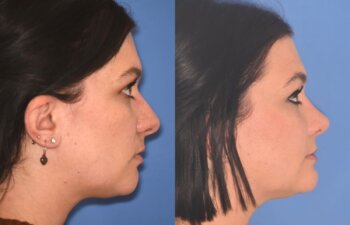 31 YR - 4 Months Postop: Rhinoplasty