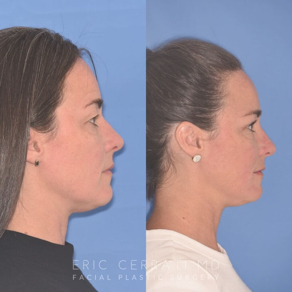 40 YR - 5 Weeks Postop: Upper Blepharoplasty