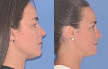 40 YR - 5 Weeks Postop: Upper Blepharoplasty