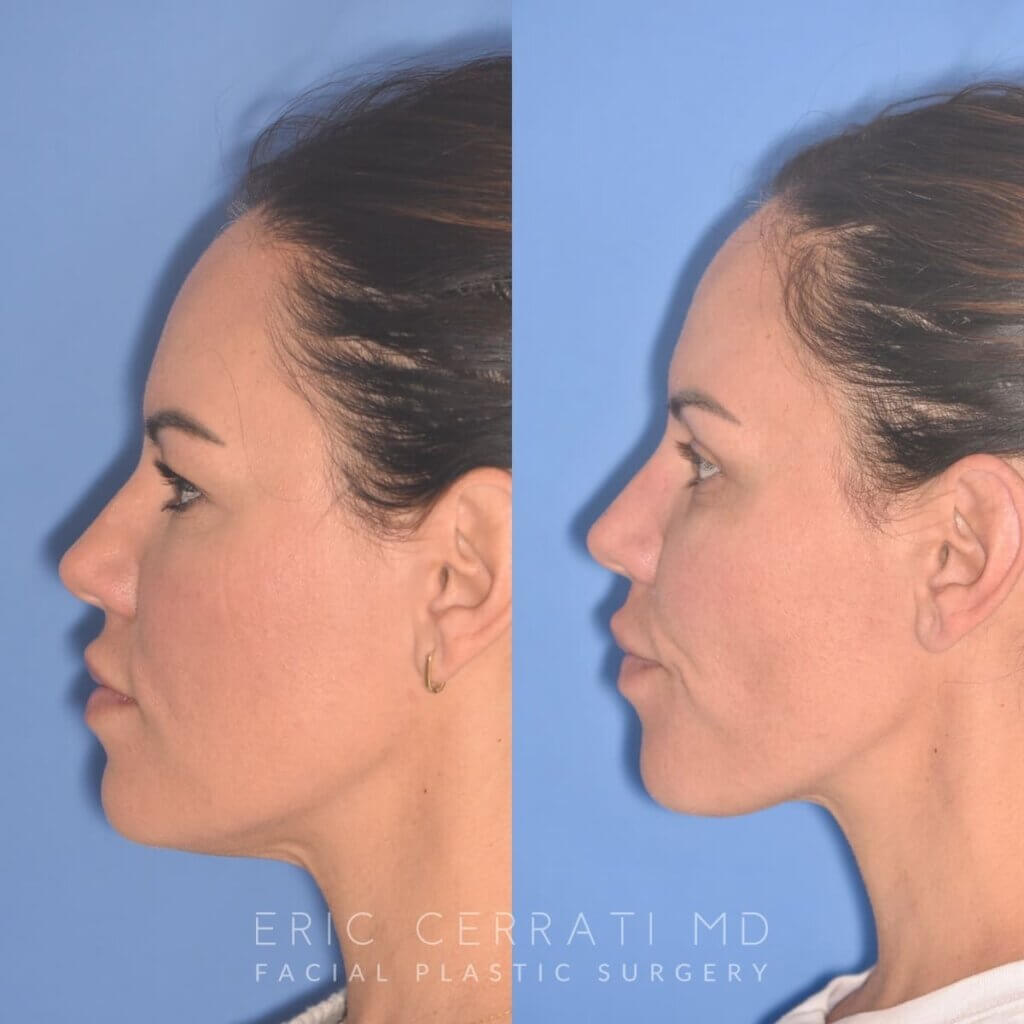 42 YR - 5 Weeks Postop: Upper Blepharoplasty