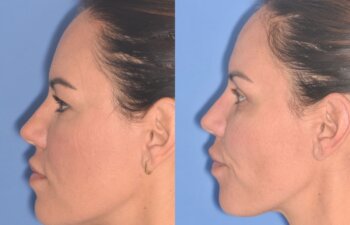 42 YR - 5 Weeks Postop: Upper Blepharoplasty