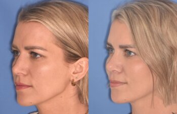 35 YR - 5 Weeks Postop: Rhinoplasty