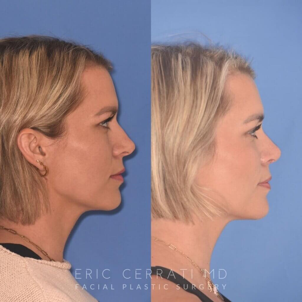 35 YR - 5 Weeks Postop: Rhinoplasty