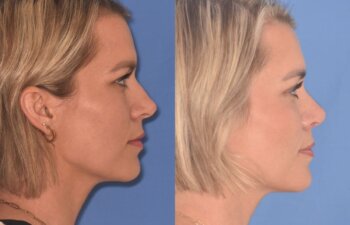 35 YR - 5 Weeks Postop: Rhinoplasty