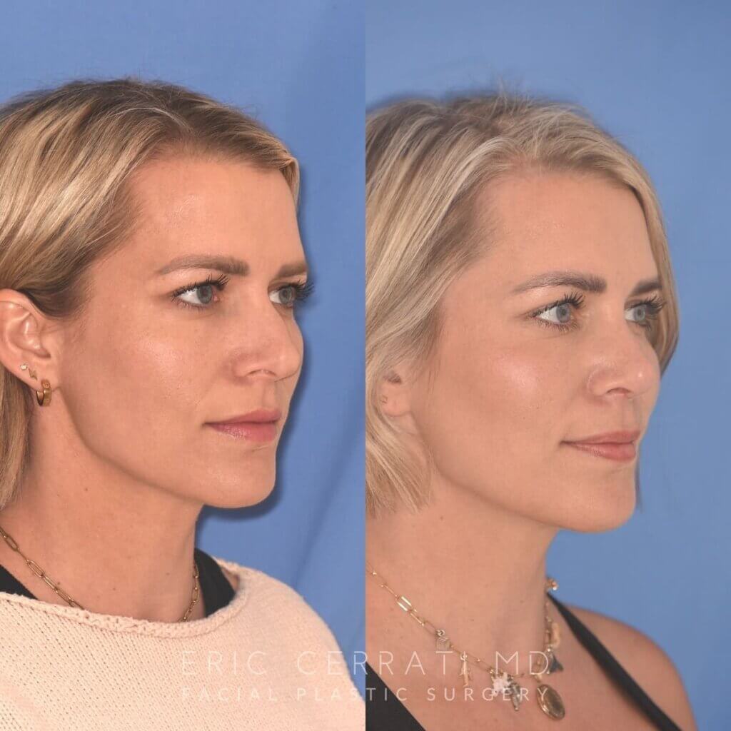 35 YR - 5 Weeks Postop: Rhinoplasty
