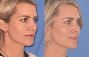 35 YR - 5 Weeks Postop: Rhinoplasty
