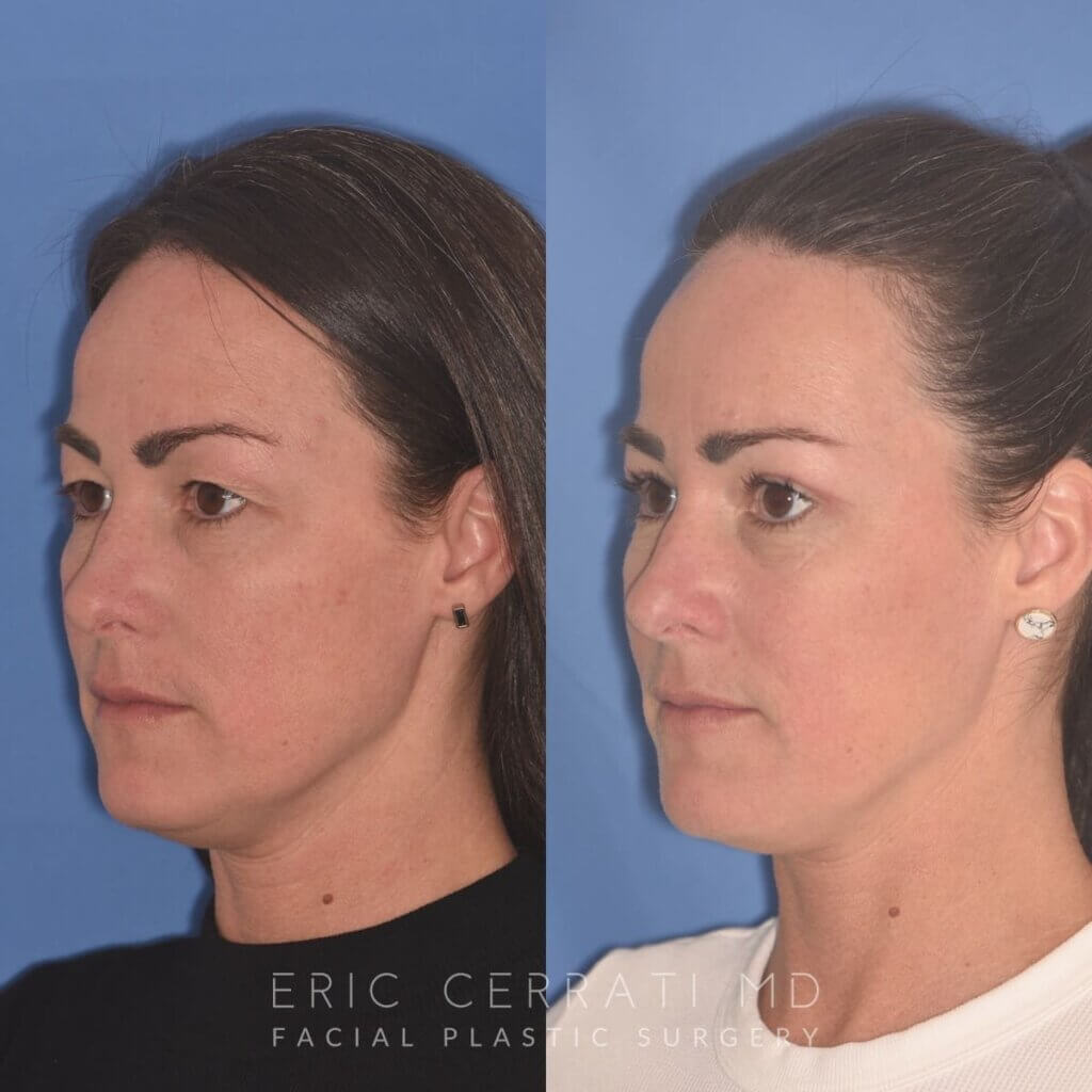 40 YR - 5 Weeks Postop: Upper Blepharoplasty