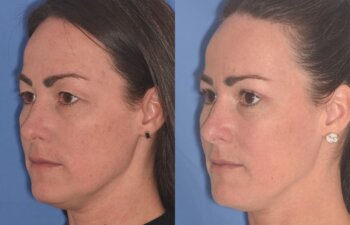 40 YR - 5 Weeks Postop: Upper Blepharoplasty