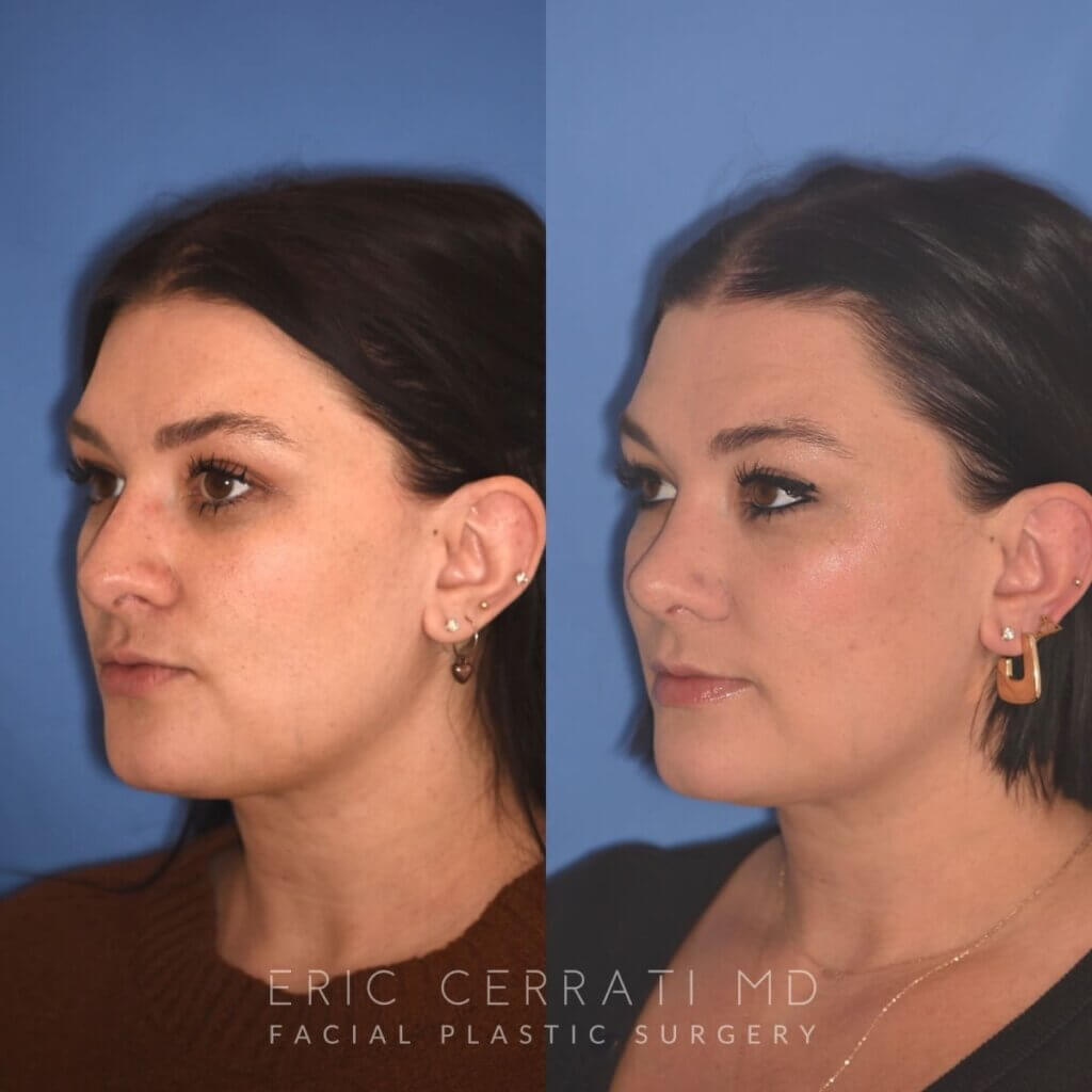 31 YR - 4 Months Postop: Rhinoplasty