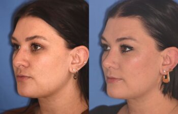 31 YR - 4 Months Postop: Rhinoplasty
