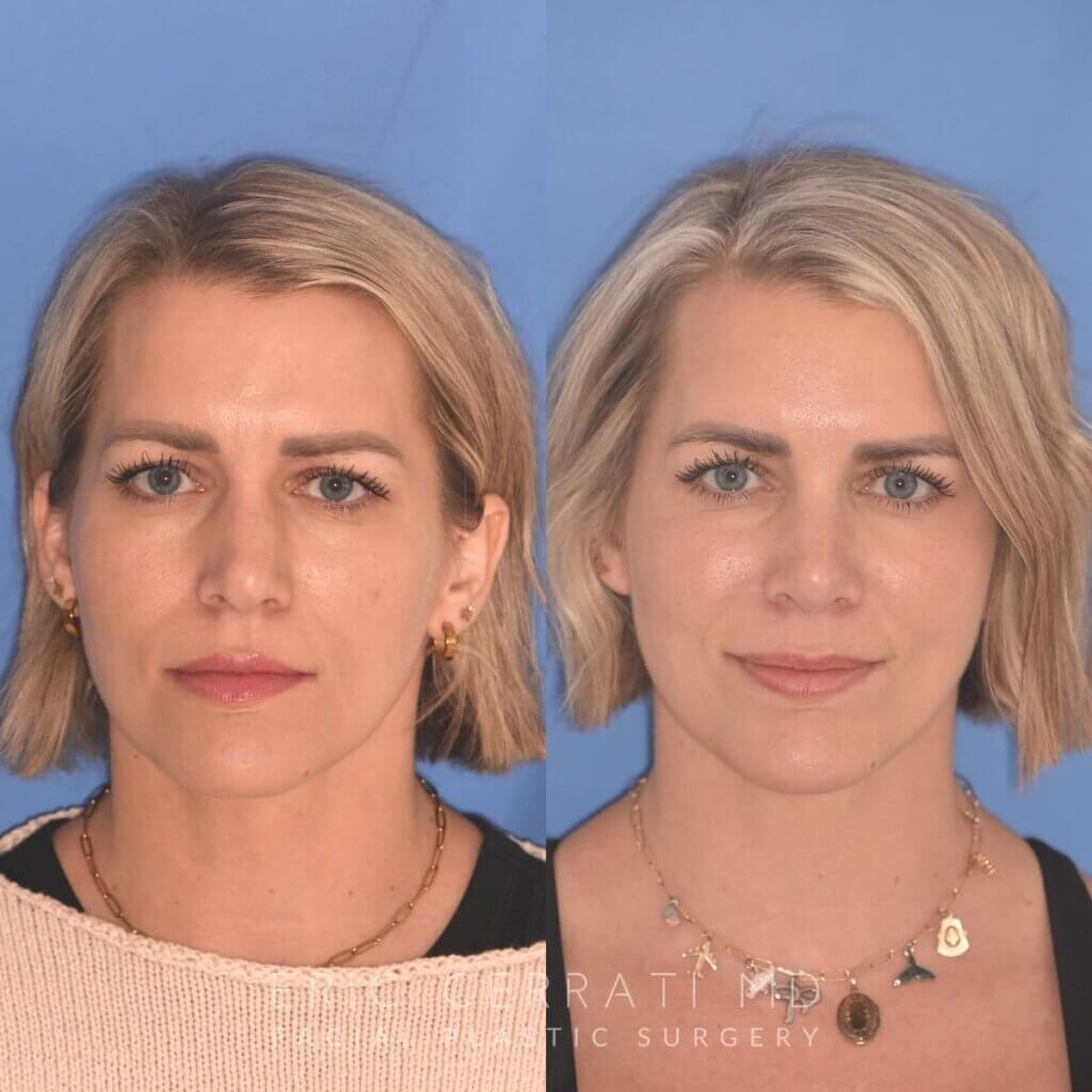 35 YR - 5 Weeks Postop: Rhinoplasty